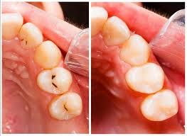 Dental fillings. Before and After