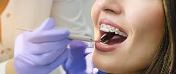 Ab welchem alter wird eine zahnspange für kinder empfohlen? Zahnspange Erwachsene Behandlung Und Kosten