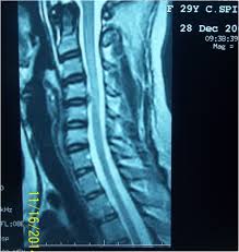 Edwin josé calderón flores cirujano de cabeza, cuello y maxilofacial miembro de la sociedad peruana de cirugía de cabeza, cuello y maxilofacial cmp: Single Level Anterior Cervical Discectomy And Fusion Versus Dynamic Cervical Implant Clinical And Radiological Outcome The Egyptian Journal Of Neurology Psychiatry And Neurosurgery Full Text
