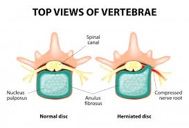 If you ever find yourself sleeping on your stomach daily, try to adjust. Chiropractic Treatment For A Herniated Disc