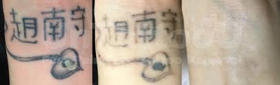 6 months #lasertattooremoval #picosure #tattooremoval #untattoou #cynosure #lasertattooremovalexperts #lasertattooremovalspecialists #inked #tattoos #tattooregret. Untattoou Pa Twitter Untattoou Laser Tattoo Removal Before After All Black Professional Tattoo Located On Wrist Approximately 2 Square Inches In Size Age Of Tattoo 6 Months Lasertattooremoval Picosure Tattooremoval Untattoou
