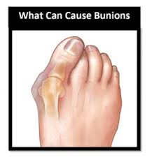 Check spelling or type a new query. How To Avoid Bunion Surgery Gold Coast Podiatrist