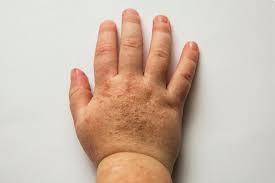 La scarlattina, a differenza della altre malattie esantematiche come il morbillo o la rosolia, non dà immunità una volta contratta: Scarlattina Come Prevenire Il Contagio Deabyday