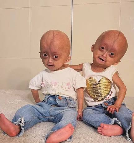 Nossas sinceras condolências à família de Elis, que faleceu hoje, aos 5  anos. À sua irmã gêmea, Eloá, e a todos que a amam, deixamos nosso carinho  e solidariedade neste momento de
