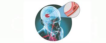 Un coágulo se puede desprender de otro lugar de los vasos sanguíneos del cerebro, o de alguna parte en el cuerpo, y trasladarse hasta el. Accidentul Vascular Cerebral Apollus Institute Clinica Bucuresti