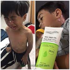 After dah kering kesan cp tu, masa tu la dia aktif nak mengeram kat another human body. Ubat Chicken Pox Athirahassin