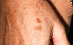 Doesn't matter if they are from walmart or restoration hardware. Freckles Causes Identification And Risks