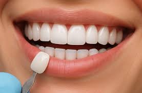 Are Veneers Permanent? What You Should Know - The Windsor Dental Practice