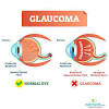 Glaucoma is a group of eye diseases that can cause vision loss and blindness by damaging the optic nerve, the bundle of nerve fibers that connects the retina with the brain to produce sight. 1