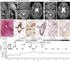 In addition, we also present a unique case of newly described autoimmune entity clippers syndrome. A Case Of Clippers Syndrome Responsive To Tocilizumab Neurology Neuroimmunology Neuroinflammation