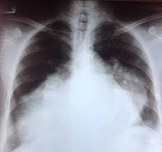 Most of the time, it is caused by an infection that reaches the heart. Rheumatic Heart Disease Radiology Reference Article Radiopaedia Org
