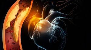Ischemic Heart Disease-Transient Ischemic Attack-Causes-Symptoms-Diagnosis-Treatment- | Homeopathic | Best Homeopathic Doctor in Pakistan | Dr Qaisar Ahmed MD, DHMS