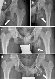 Surgery is never a go to option for any doctors, but sometimes it is necessary. Treatment For Ischial Tuberosity Avulsion Fractures In Adolescent Athletes Springerlink