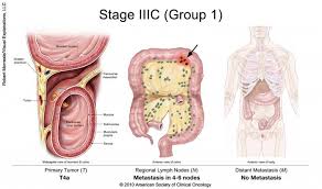 Bowel cancer is where the disease starts in the large intestines. Colorectal Cancer Stages Cancer Net