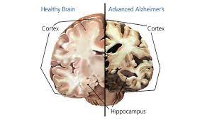 Maybe you would like to learn more about one of these? Alzheimer S Disease And Dementia Today