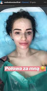 Ewelina evelynn lisowska (23.08.1991) born and raised in cerekwica. Ewelina Lisowska Zafundowala Sobie Wampirzy Lifting Obszerna Relacje Z Zabiegu Zamiescila Na Instagramie Komarek Gryzie Oj Oj