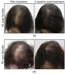 Cancer is a dreadful thing. Representative Photographs Of Hair Re Growth Before And After Download Scientific Diagram