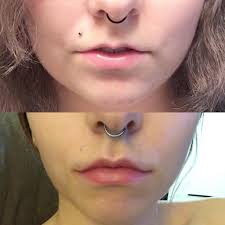This makes your upper lip subtly more full. Lip Fillers 2ml Over 6 Months Plus A Botox Lip Flip Results After 2 Weeks Plasticsurgery
