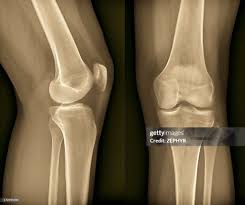 Image result for Knee XRay