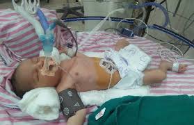 Being born at 7 months gestation is no joke. A Preterm Baby Born In 7 Months 31 Pmg Children Hospital Facebook