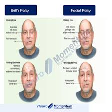 Maybe you would like to learn more about one of these? Bell S Palsy Vs Facial Palsy Some Neuromomentum Clinic Facebook