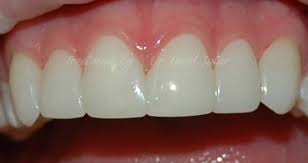 In such situations, braces are used to fit into your teeth to align the teeth in a precise manner. 4 Methods To Close Gaps Between Teeth Trusted Dental Gold Coast