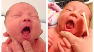 Image result for Ankyloglossia
