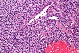 Image result for Glomus tumor