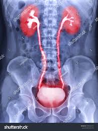 Image result for Intravenous Pyelogram