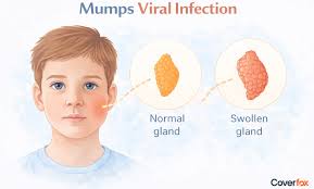 Image result for Mumps
