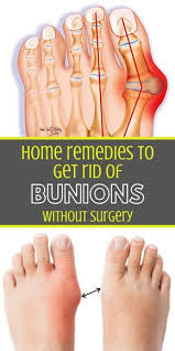 Get Rid Of Bunions Get Rid Of Bunions Naturally Get Rid Of Bunions Naturally Home Remedies How To Get Rid Of Bu Get Rid Of Bunions Bunion Remedies Bunion