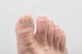 Image result for Clubbing nails feet