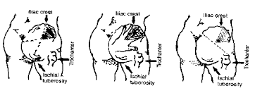 Determine how to administer the injection. Indian Pediatrics Editorial