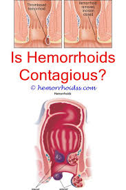 How To Deadlift Without Getting Hemorrhoids How To Use Alum Powder For Hemorrhoids Can Hemorr Hemorrhoids Treatment Bleeding Hemorrhoids Cure For Hemorrhoids
