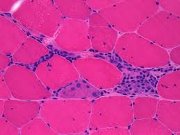 Image result for Polymyositis