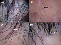 It resides in the dermal layer of the skin and is made up of 20 different cell types, each with distinct functions. Evaluation Of A Handheld Dermatoscope In Clinical Diagnosis Of Primary Cicatricial Alopecias Springerlink