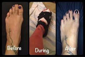 85% of bunion operations are successful with minimal side effects. Life Is Shourt Bunion Surgery Bunion Surgery Foot Surgery Recovery Bunion