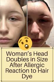 Woman S Head Doubles In Size After Allergic Reaction To Hair Dye Health Facts Interesting Amazing Life Fitness Goruntuler Ile