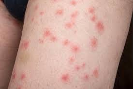 Maybe you would like to learn more about one of these? Bedbugs Nhs
