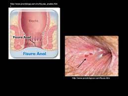 Here's why ingrown hairs form and how you can get rid of what is an ingrown hair? Rectum And Anus Diseases