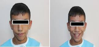 FT39 Urofacial Syndrome (Ochoa Syndrome) : A Case Report Ürofasiyal Sendrom  (Ochoa Sendromu) : Olgu Sunumu Gülüzar GÜRHAN1,