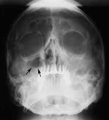26 Paranasal Sinus Diseases Pocket Dentistry