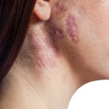 Sin las vacunas, las epidemias causadas por muchas enfermedades prevenibles podrían reaparecer y estabilizantes: Birthmark Mole Hemangioma Mongolian Spot Medlineplus