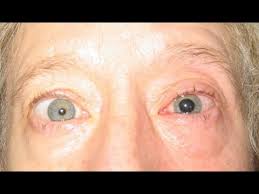 Cactus spines are not poisonous for humans or animals. Euphorbia Plant Shoots Seattle Woman In Eye With Poisonous Sap As She Gardens Youtube
