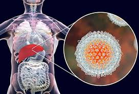 When someone is first infected with the hepatitis c virus, they can have a very mild illness with few or no symptoms or a serious condition requiring hospitalization. Is Hepatitis C Contagious How Do You Get It