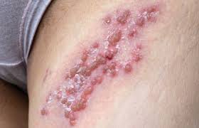 Image result for genital herpes