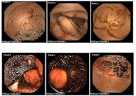 Image result for Small Intestinal Bleeding