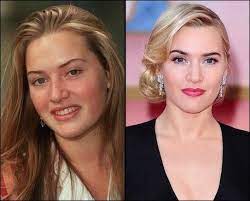 Life is short, and it is here to be lived #katewinslet. Kate Winslet Mit Plastischer Chirurgie Oder Nicht Chirurgie Nicht Plastischer Winslet Kate Winslet Celebrity Plastic Surgery Nose Job
