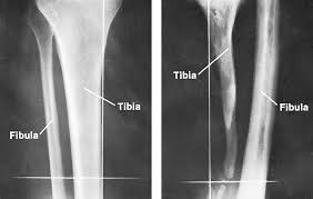 Image result for Osteomyelitis