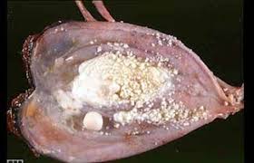 Bladder Stones